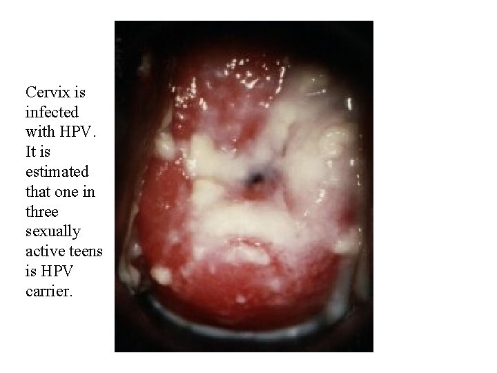 Cervix is infected with HPV. It is estimated that one in three sexually active