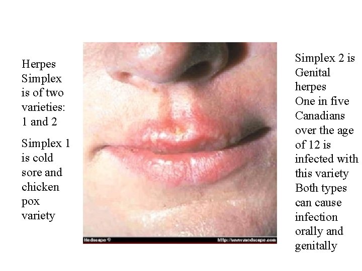 Herpes Simplex is of two varieties: 1 and 2 Simplex 1 is cold sore