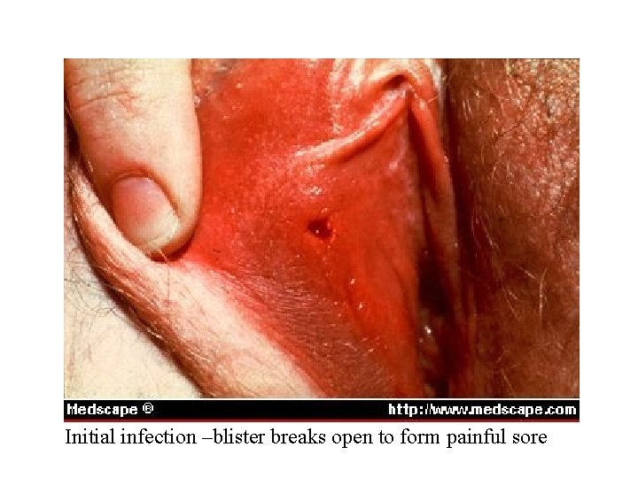 Initial infection –blister breaks open to form painful sore 