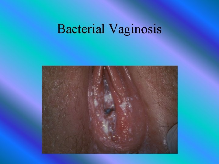 Bacterial Vaginosis 