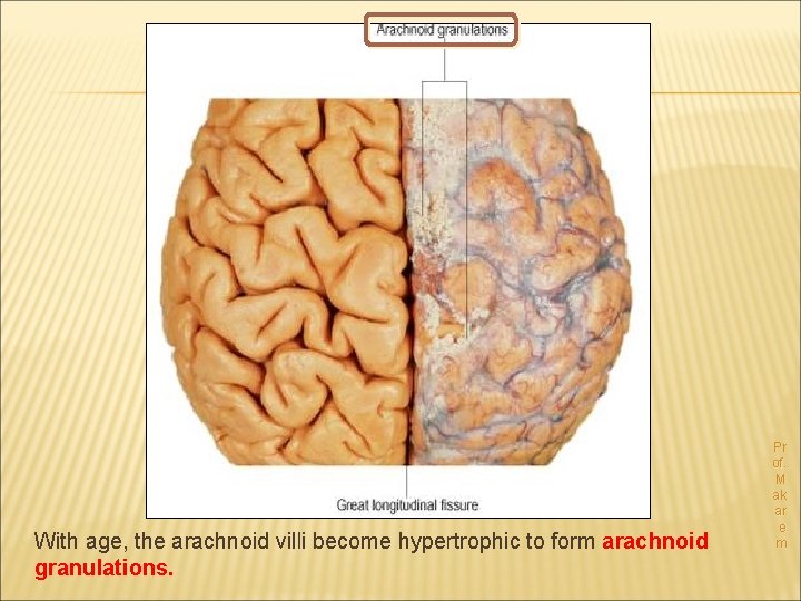 With age, the arachnoid villi become hypertrophic to form arachnoid granulations. Pr of. M