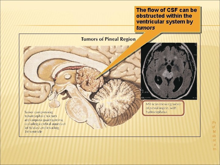 The flow of CSF can be obstructed within the ventricular system by tumors Pr