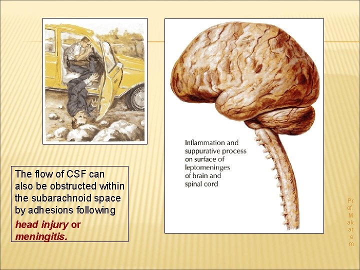 The flow of CSF can also be obstructed within the subarachnoid space by adhesions