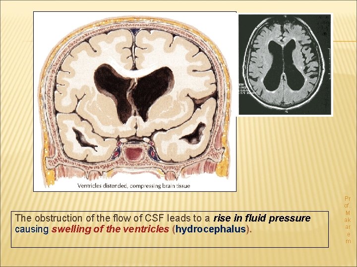 The obstruction of the flow of CSF leads to a rise in fluid pressure