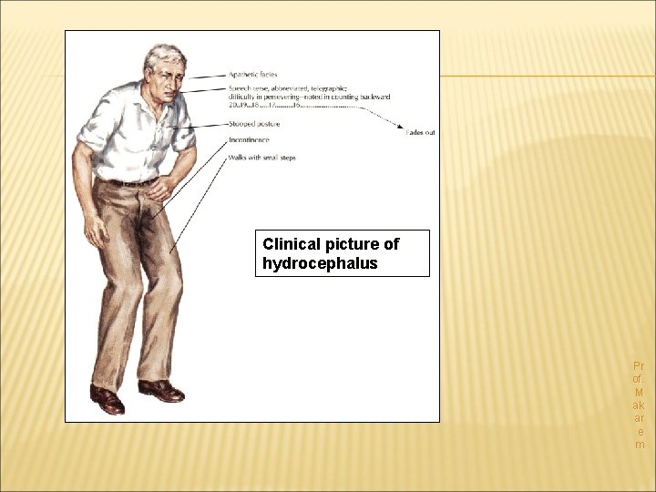 Clinical picture of hydrocephalus The clinical effects are similar to those of a brain