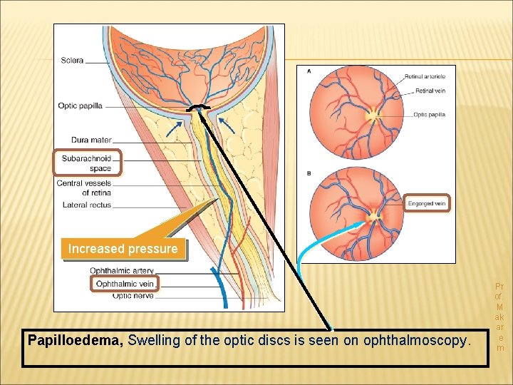 Increased pressure Papilloedema, Swelling of the optic discs is seen on ophthalmoscopy. Pr of.