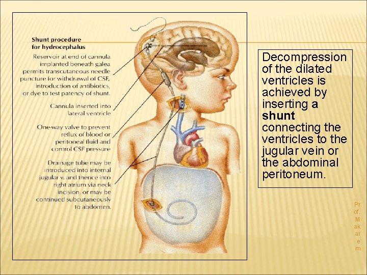 Decompression of the dilated ventricles is achieved by inserting a shunt connecting the ventricles