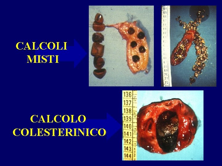 CALCOLI MISTI CALCOLO COLESTERINICO 