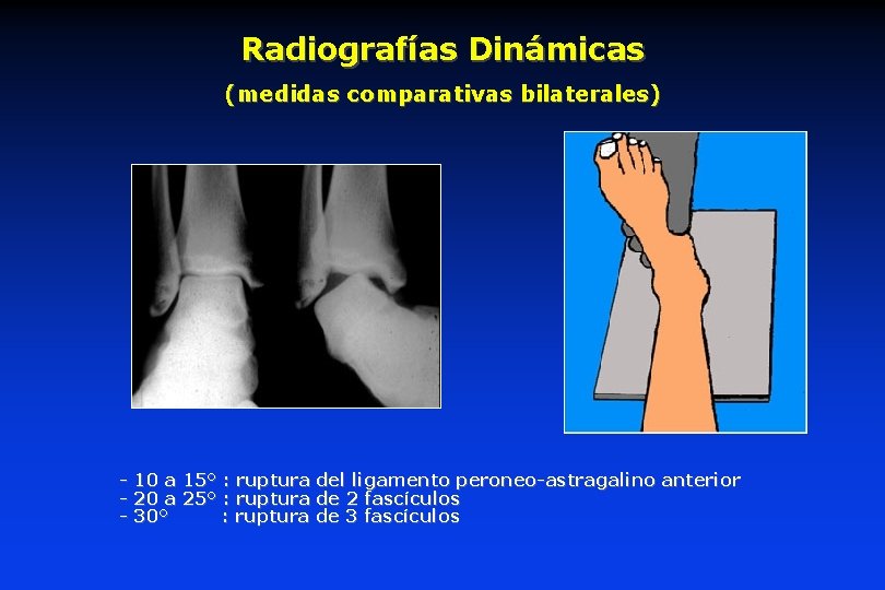 Radiografías Dinámicas (medidas comparativas bilaterales) - 10 a 15° : ruptura del ligamento peroneo-astragalino