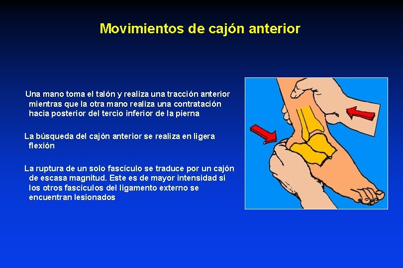 Movimientos de cajón anterior Una mano toma el talón y realiza una tracción anterior