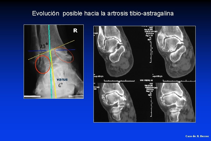 Evolución posible hacia la artrosis tibio-astragalina Caso de JL Bessec 