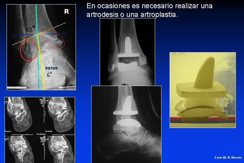 En ocasiones es necesario realizar una artrodesis o una artroplastia. Caso de JL Bessec