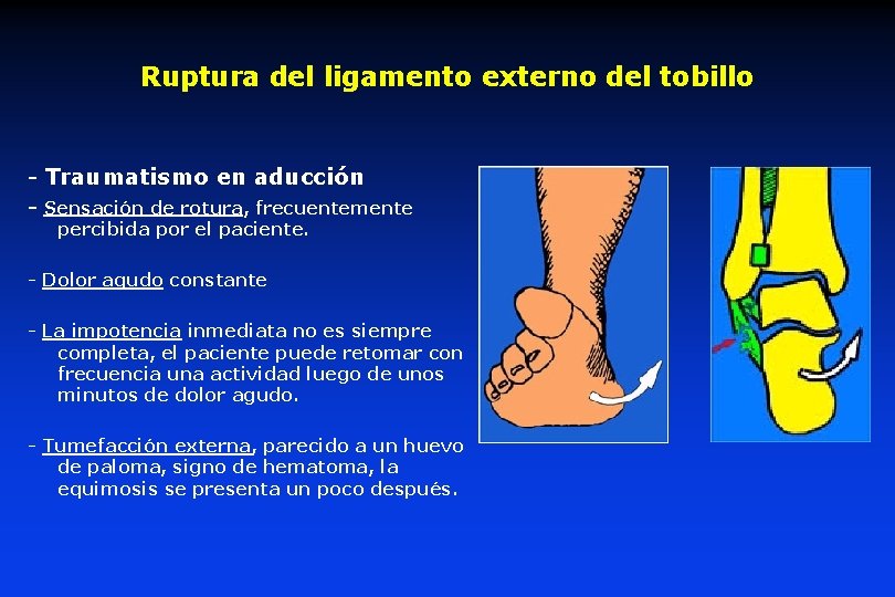 Ruptura del ligamento externo del tobillo - Traumatismo en aducción - Sensación de rotura,