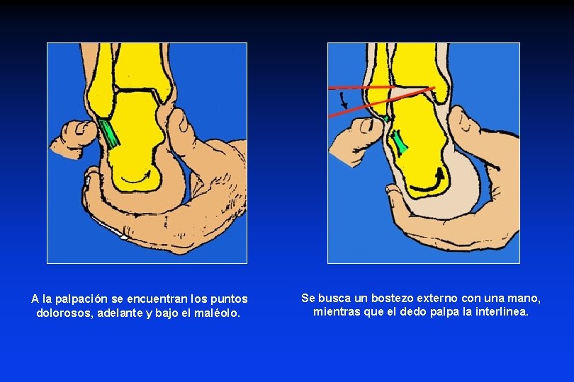 A la palpación se encuentran los puntos dolorosos, adelante y bajo el maléolo. Se