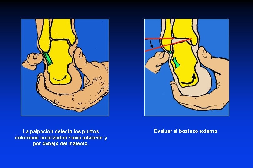 La palpación detecta los puntos dolorosos localizados hacia adelante y por debajo del maléolo.