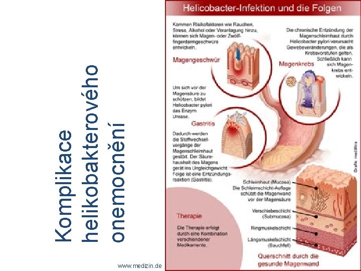 www. medizin. de Komplikace helikobakterového onemocnění 