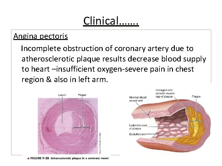 Clinical……. Angina pectoris Incomplete obstruction of coronary artery due to atherosclerotic plaque results decrease