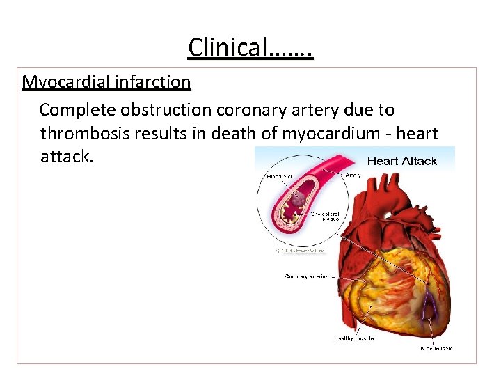 Clinical……. Myocardial infarction Complete obstruction coronary artery due to thrombosis results in death of