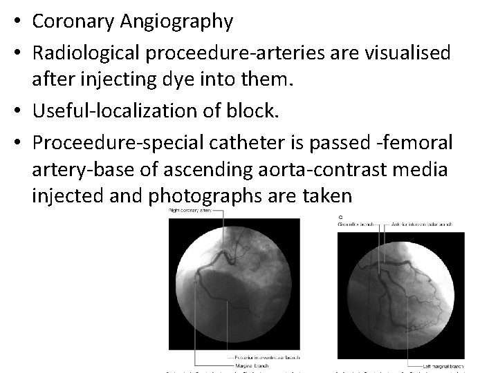  • Coronary Angiography • Radiological proceedure-arteries are visualised after injecting dye into them.
