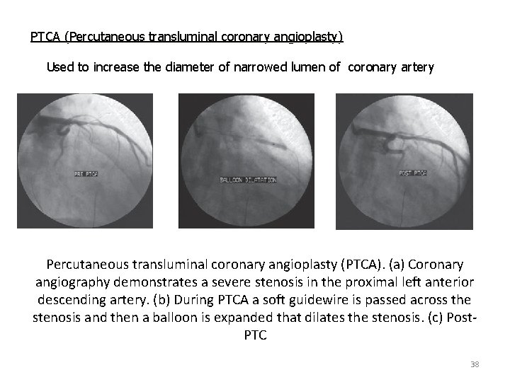 PTCA (Percutaneous transluminal coronary angioplasty) Used to increase the diameter of narrowed lumen of