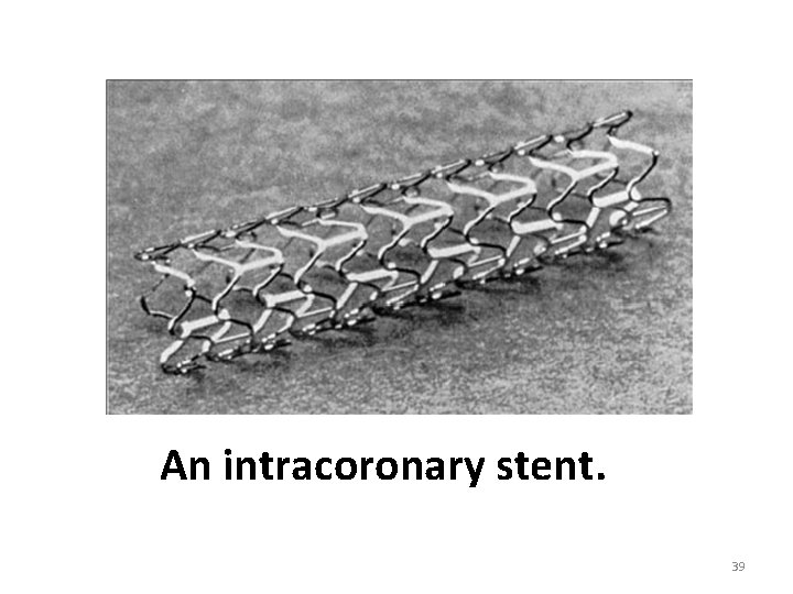 An intracoronary stent. 39 