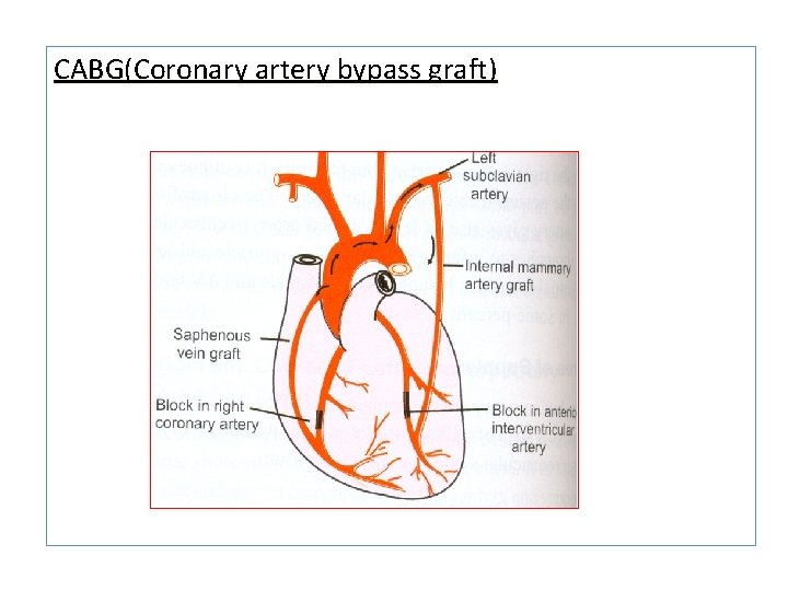 CABG(Coronary artery bypass graft) 