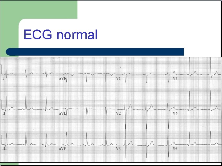 ECG normal 