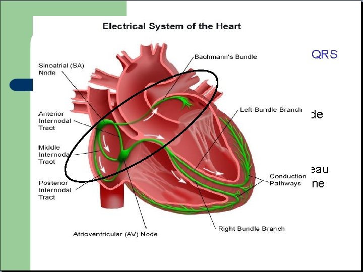 TACHYCARDIES SUPRA VENTRICULAIRES , A QRS FIN (<120 ms) -Prennent leur origine au niveau