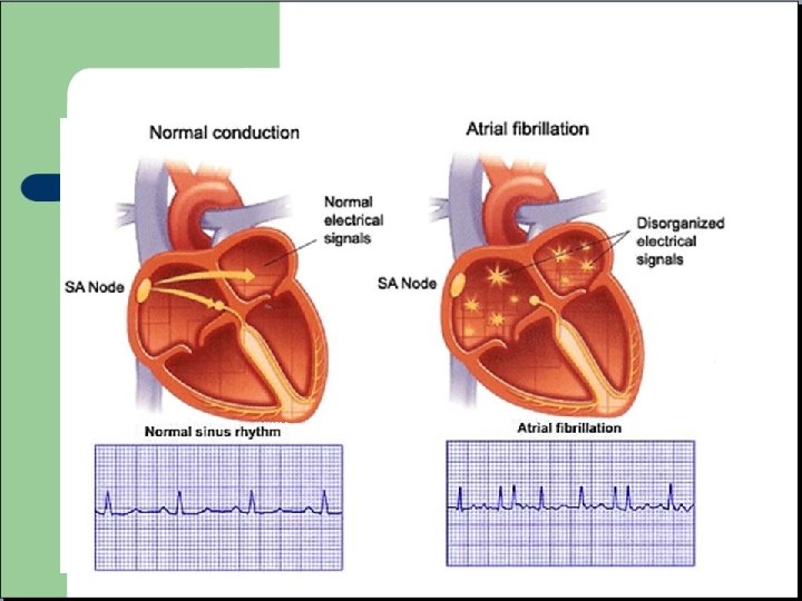 Fibrillation Auriculaire 