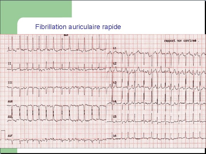 Fibrillation auriculaire rapide 