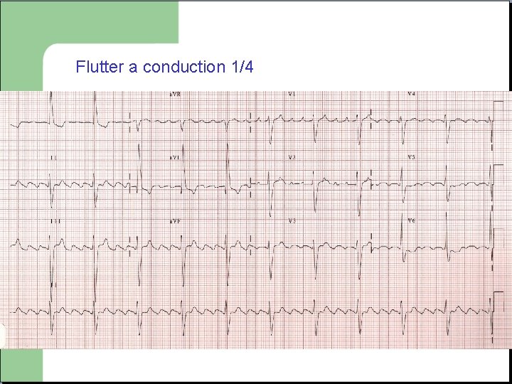 Flutter a conduction 1/4 