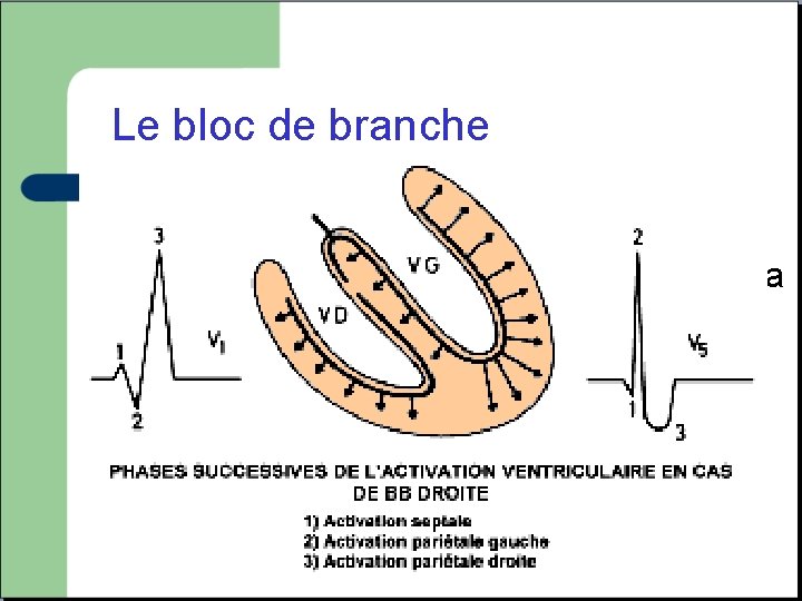 Le bloc de branche Elargissement du QRS (plus de 120 ms) lié a une