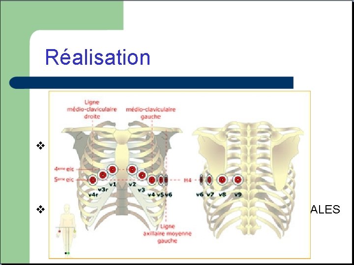 Réalisation v Electrodes toujours placées aux mêmes points. v 2 types d’électrodes, PRECORDIALES et