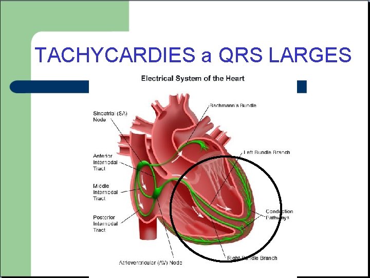 TACHYCARDIES a QRS LARGES 