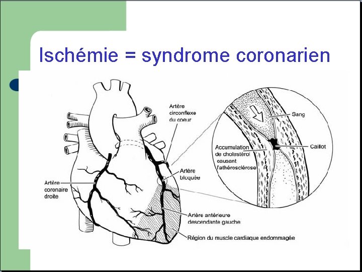 Ischémie = syndrome coronarien Inadéquation entre les apports et les besoins en oxygène au