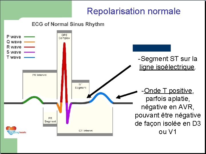 Repolarisation normale -Segment ST sur la ligne isoélectrique. -Onde T positive, parfois aplatie, négative