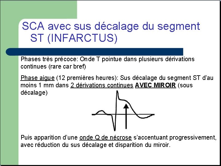 SCA avec sus décalage du segment ST (INFARCTUS) Phases très précoce: Onde T pointue