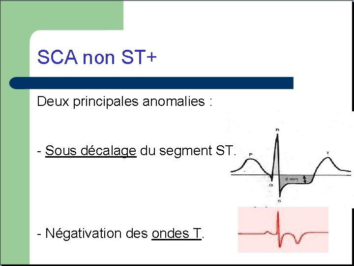 SCA non ST+ Deux principales anomalies : - Sous décalage du segment ST. -