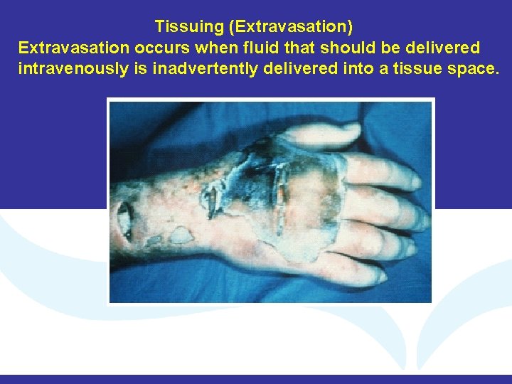 Tissuing (Extravasation) Extravasation occurs when fluid that should be delivered intravenously is inadvertently delivered