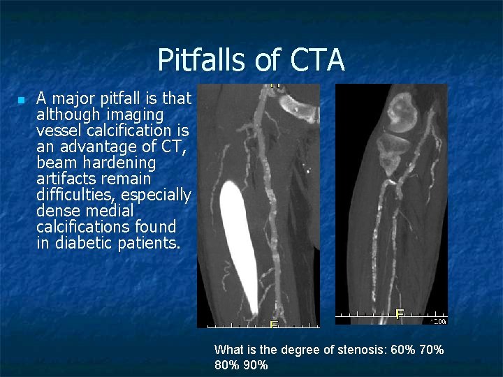 Pitfalls of CTA n A major pitfall is that although imaging vessel calcification is