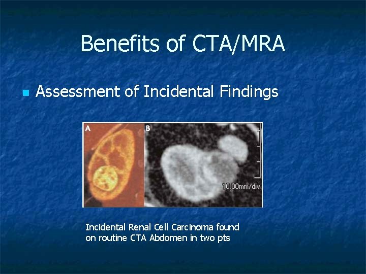 Benefits of CTA/MRA n Assessment of Incidental Findings Incidental Renal Cell Carcinoma found on
