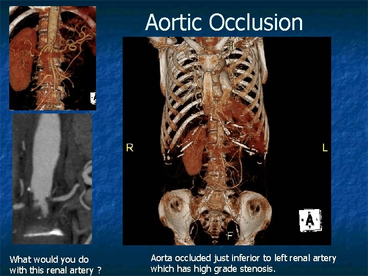 Aortic Occlusion What would you do with this renal artery ? Aorta occluded just