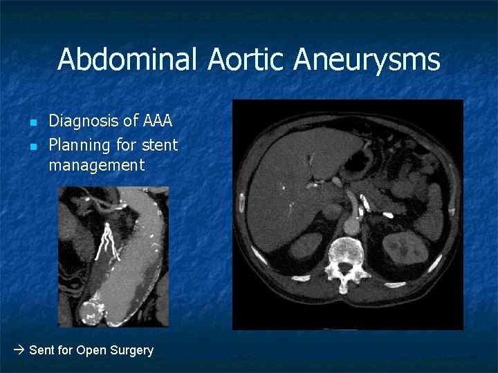 Abdominal Aortic Aneurysms n n Diagnosis of AAA Planning for stent management Sent for