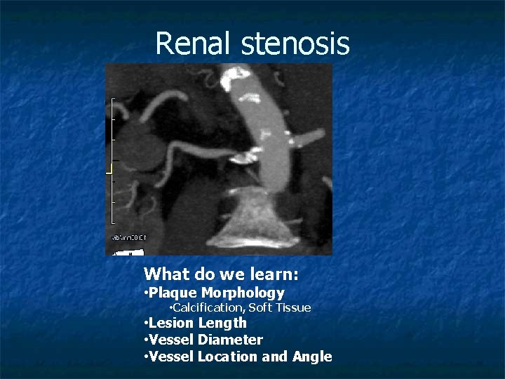 Renal stenosis What do we learn: • Plaque Morphology • Calcification, Soft Tissue •
