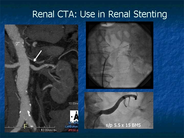Renal CTA: Use in Renal Stenting s/p 5. 5 x 15 BMS 