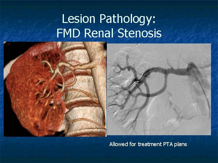 Lesion Pathology: FMD Renal Stenosis Allowed for treatment PTA plans 