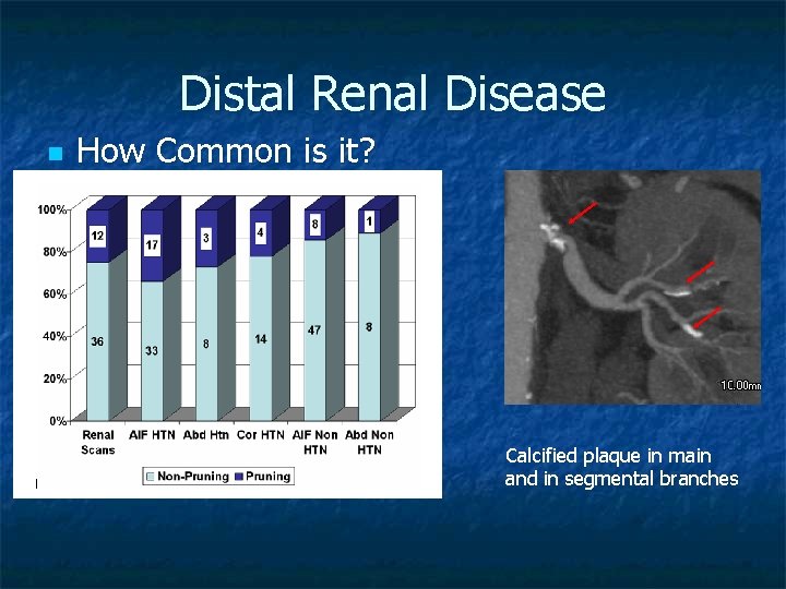 Distal Renal Disease n How Common is it? Calcified plaque in main and in