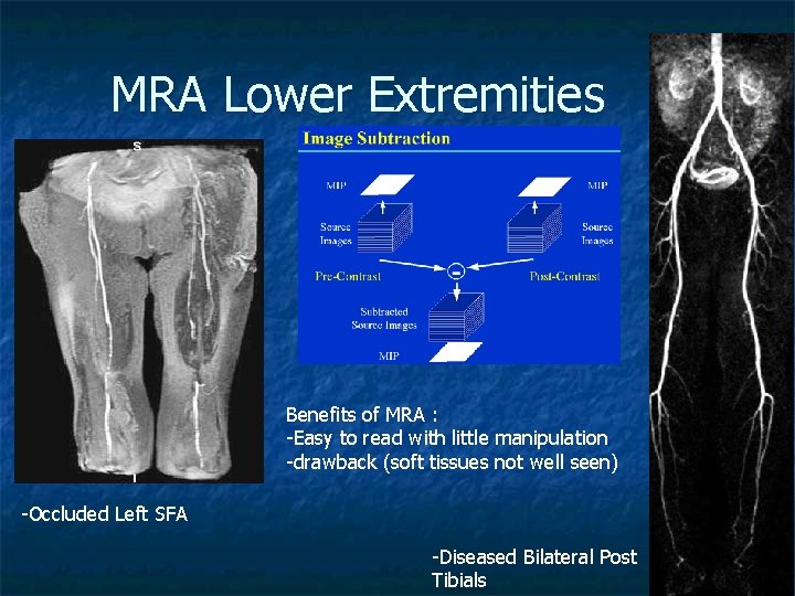 MRA Lower Extremities Benefits of MRA : -Easy to read with little manipulation -drawback