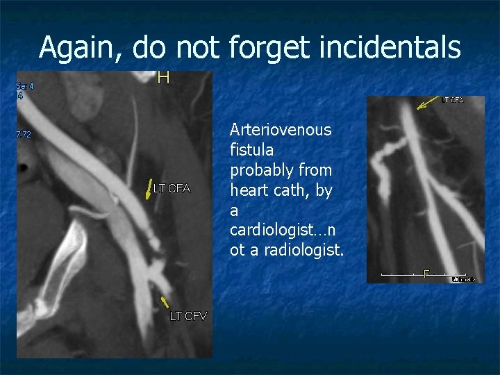 Again, do not forget incidentals Arteriovenous fistula probably from heart cath, by a cardiologist…n