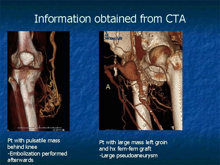 Information obtained from CTA Pt with pulsatile mass behind knee -Embolization performed afterwards Pt